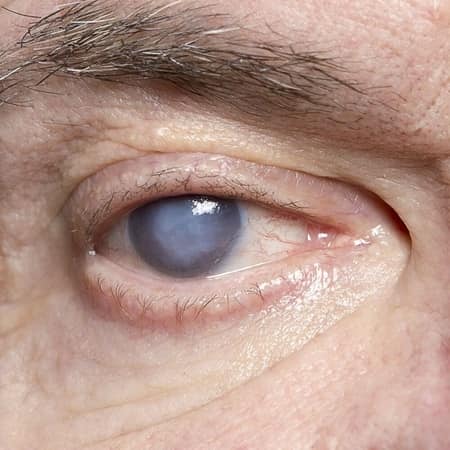 Cataract Symptom cloudy eye lens