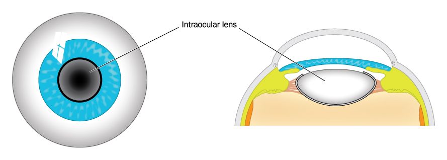 Benefits of Intraocular Lenses