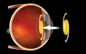 What Are Cataract Lenses