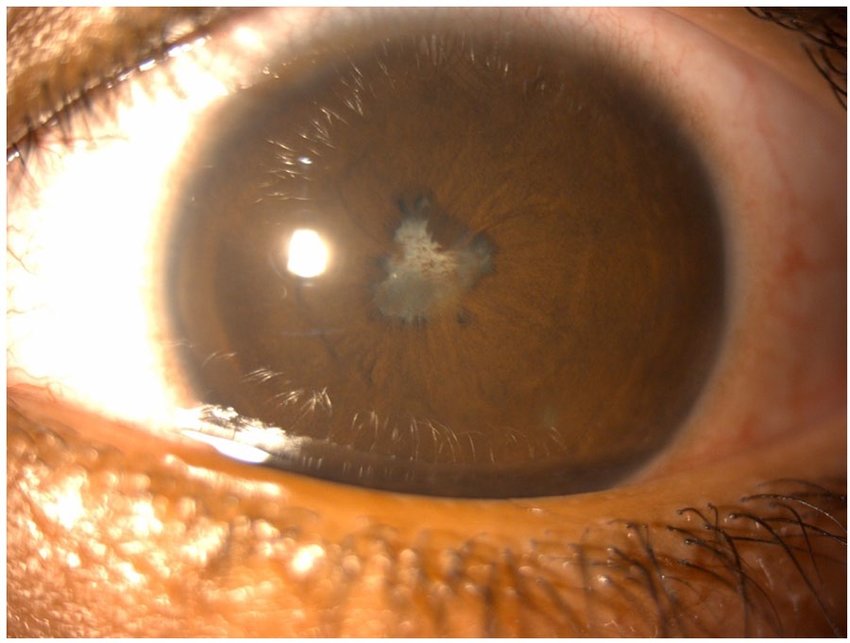 Complicated Cataract Signs Impacts And Treatment