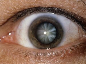 Defining Cortical Cataract