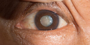 Defining Mature Cataract