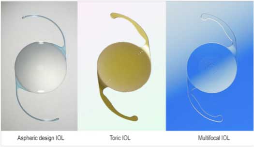 Different Types of Intraocular Lenses