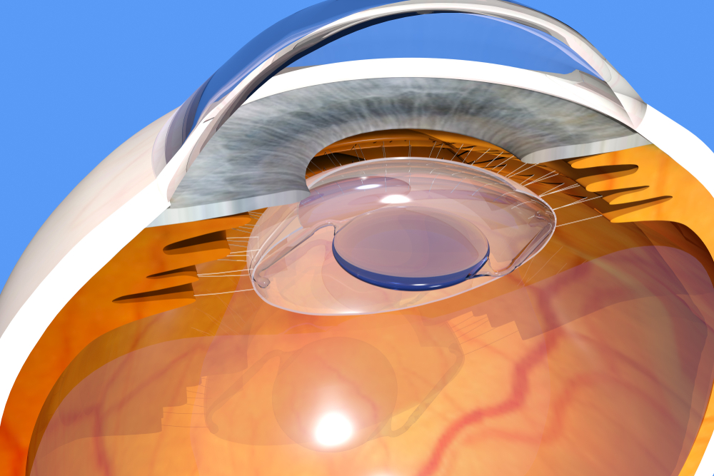 Cataract Lenses