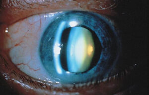 Floriform Cataract: Signs, Causes and Treatment
