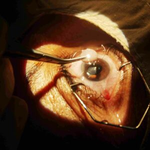 What Is The Cataract Surgery?