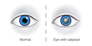 How Are Different Types of Cataracts Diagnosed?