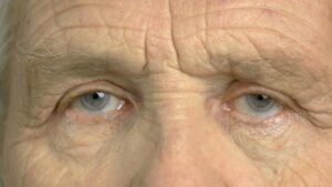 How Many Times Can One Get Secondary Cataracts?