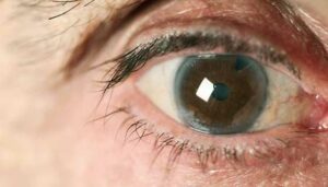 How To Treat Juvenile Cataracts?
