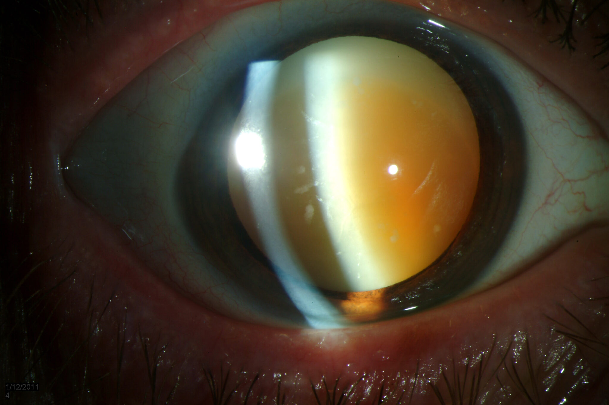 what-are-the-disadvantages-of-cataract-surgery-eyemountain