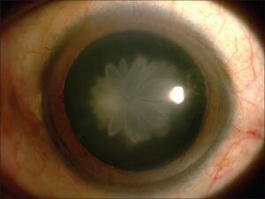 What Is A Rosette Cataract?