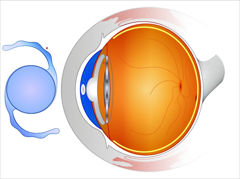 Intraocular Lenses : Different Uses, Types and Benefits