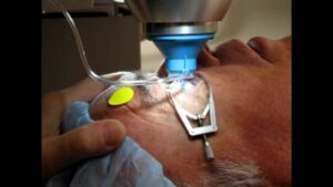 Is Laser Cataract Surgery Successful And Effective?