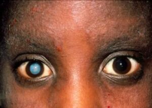Mature Cataract