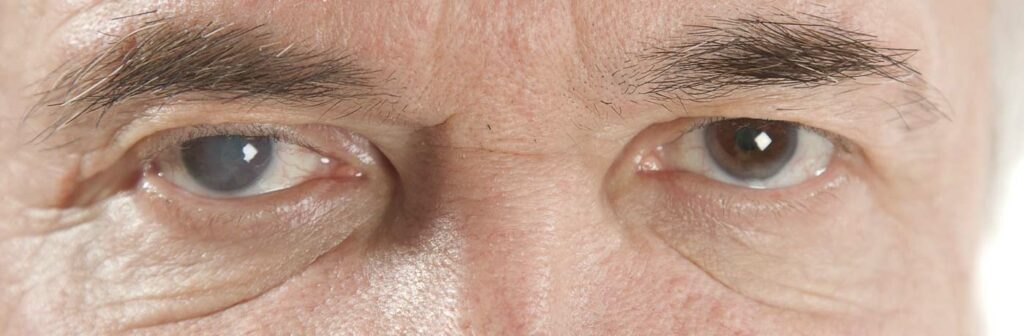 Mild Cataracts Signs, Risk Factors, Treatment Options