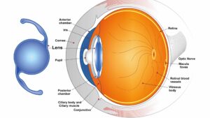 Multifocal IOLs : Working, Uses and Benefits