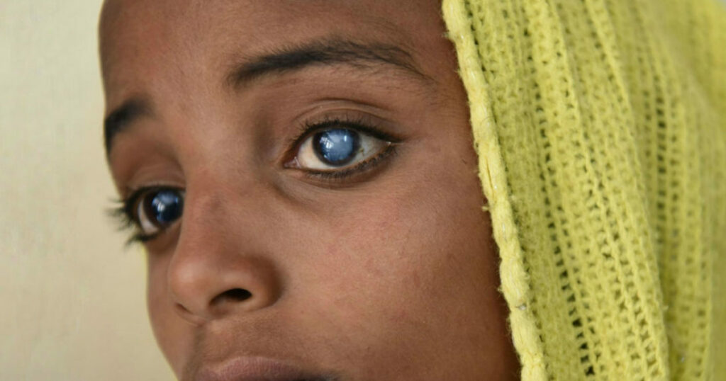 Blue Dot Cataract: Symptoms And Treatment Options