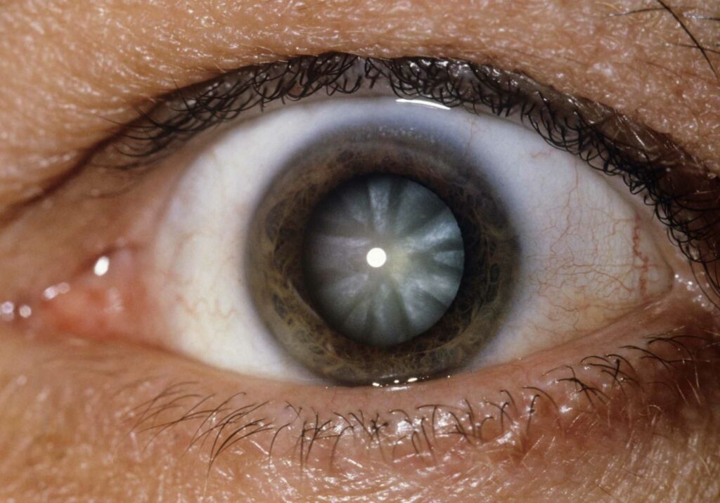 PSCC Cataract Signs , Causes and Treatment Options
