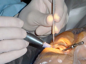 Phaco Surgery Pros, Cons, and Procedure