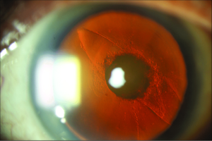 Posterior Polar Cataracts | Treatment of Posterior Polar CataractsPosterior Polar Cataracts | Treatment of Posterior Polar Cataracts
