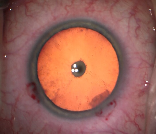 Posterior Subcapsular Cataract: Signs, Causes and Treatment Options