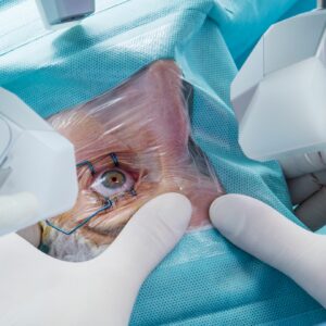 Risks of Robotic Cataract Surgery
