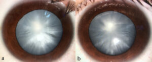 Sorbitol Cataract Other Types of Cataract
