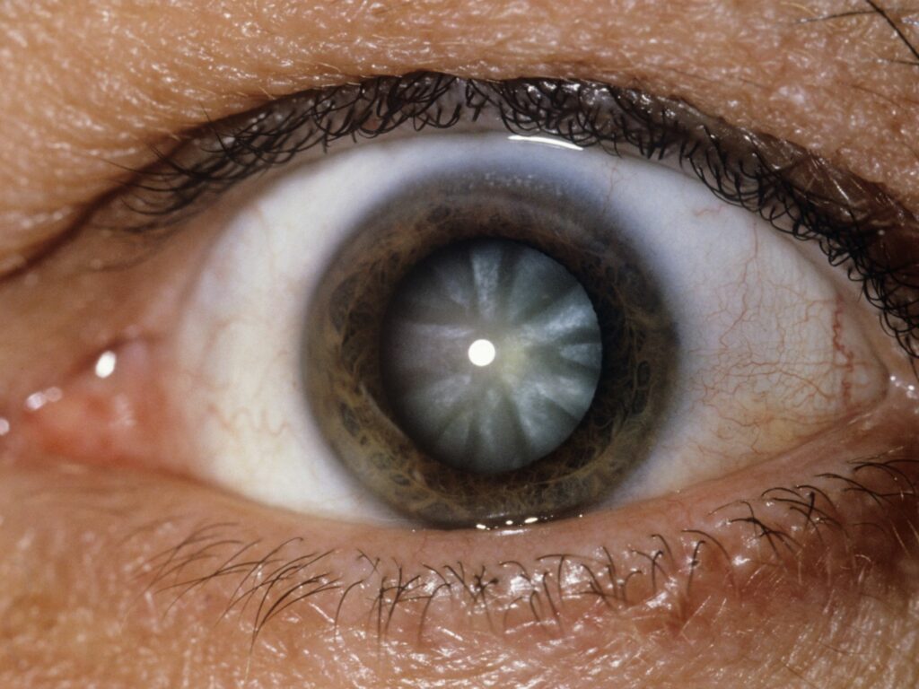 Symptoms of PSCC Cataract