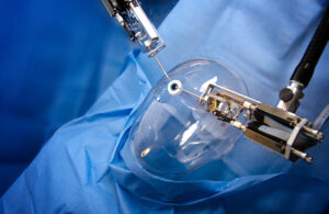The Procedure of Robotic Cataract Surgery