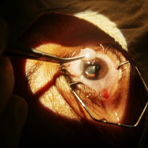 Treatment of Brown Cataracts