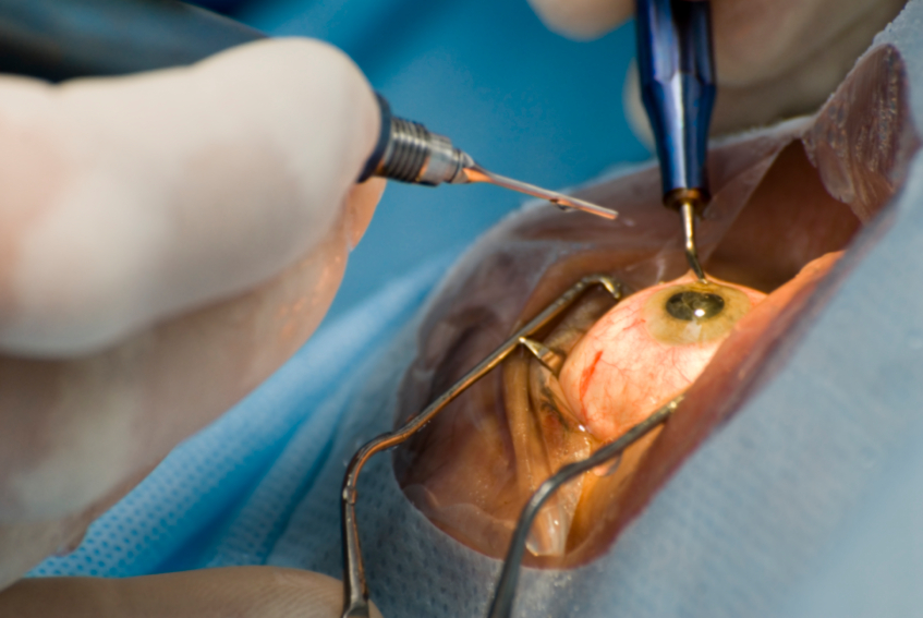 Treatment of Cataract surgery