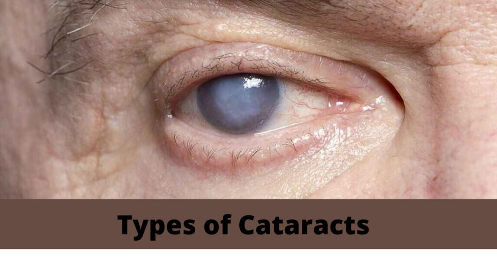 Types of Cataracts | Causes of Different Types of Cataract