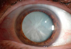 What Are Mild Cataracts?