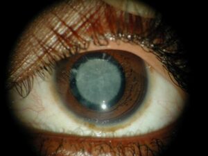 What Causes a Floriform Cataract?
