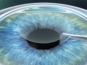 What Is Femtosecond Laser Cataract Surgery