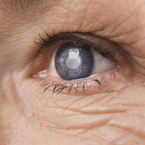 What Is a Secondary Cataract?