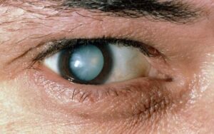 What are the Symptoms of a Nuclear Cataract?