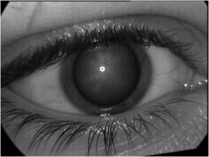 What is Sorbitol Cataract?