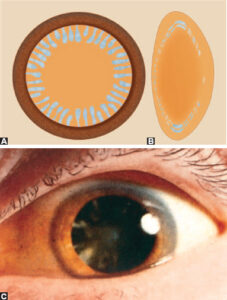 What is a Floriform Cataract?