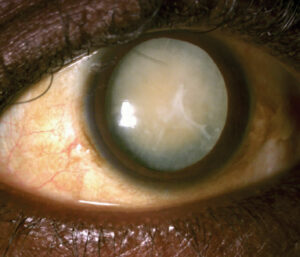 What is an Intumescent Cataract?