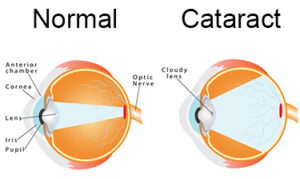 When To Use A Cataract Lens
