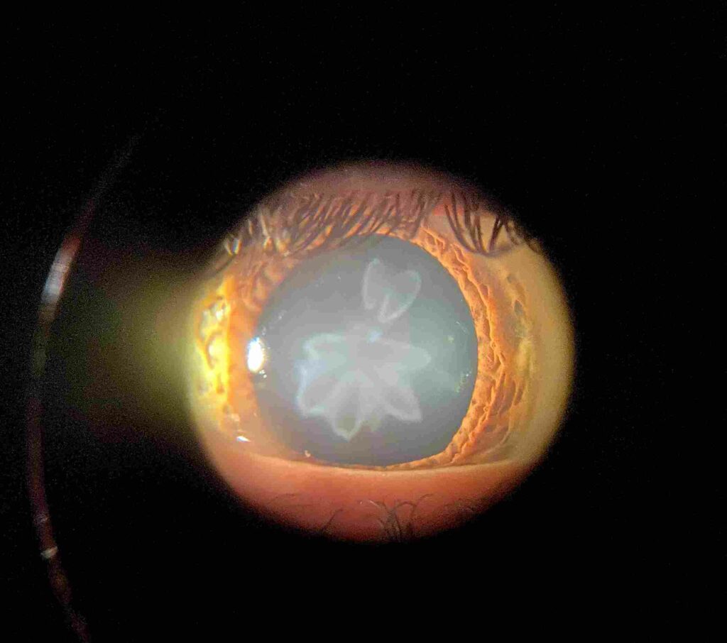 Rosette Cataract: How Can You Manage The Condition