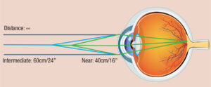 Cost of Panoptix Trifocal Lens
