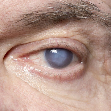 Glassblowers Cataract: Symptoms And Treatment Tips