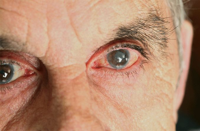 Cortical Cataract Treatment: What You Need to Know