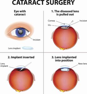 What Is Cataract Surgery?
