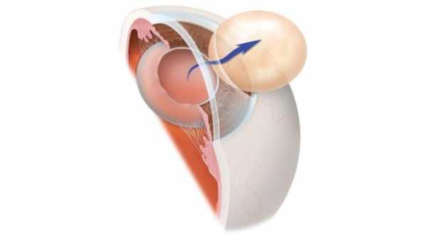 Intracapular Intracapsular Cataract Extraction: Meaning, Benefits And Risks
