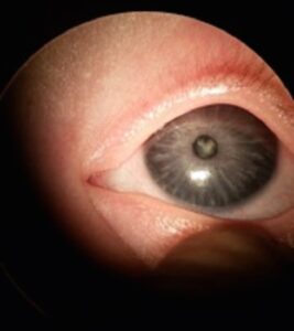 What Type Of Cataract Is Galactosemia?