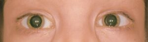 Galactosemia Cataracts: What You Need to Know