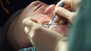 Benefits Of Choosing the Best Cataract Surgeon Near Me